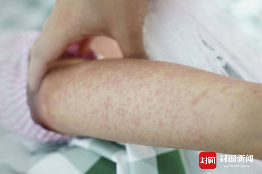 探访佛山基孔肯雅热定点医院:病床上加装了蚊帐,已有近300人治愈出院|封面头条